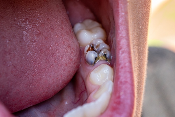 Image shwoing decayed tooth for root canal treatment in Wyoming, MI